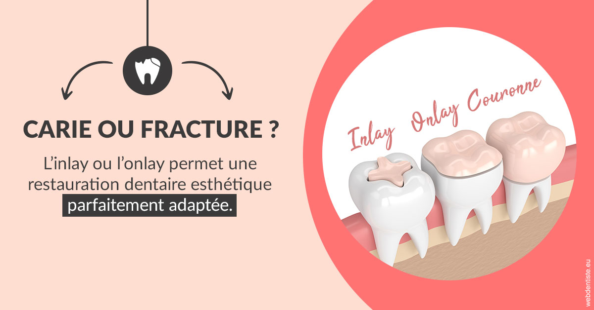 https://dr-allouche-laurent.chirurgiens-dentistes.fr/T2 2023 - Carie ou fracture 2