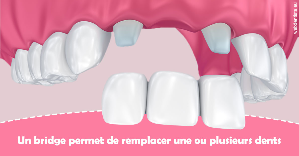https://dr-allouche-laurent.chirurgiens-dentistes.fr/Bridge remplacer dents 2
