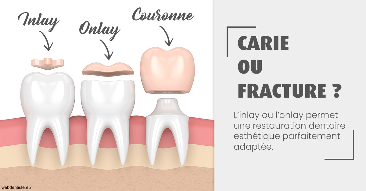 https://dr-allouche-laurent.chirurgiens-dentistes.fr/T2 2023 - Carie ou fracture 1